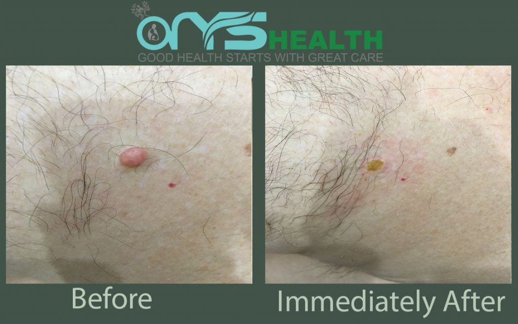 Before and after the treatment image