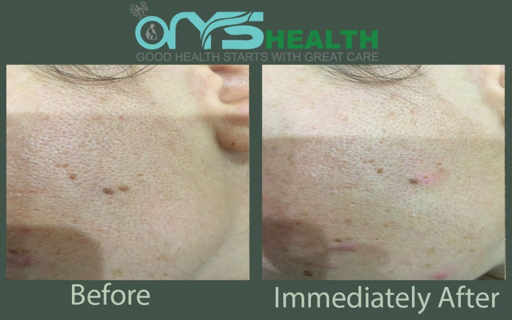 Before the after the treatment image
