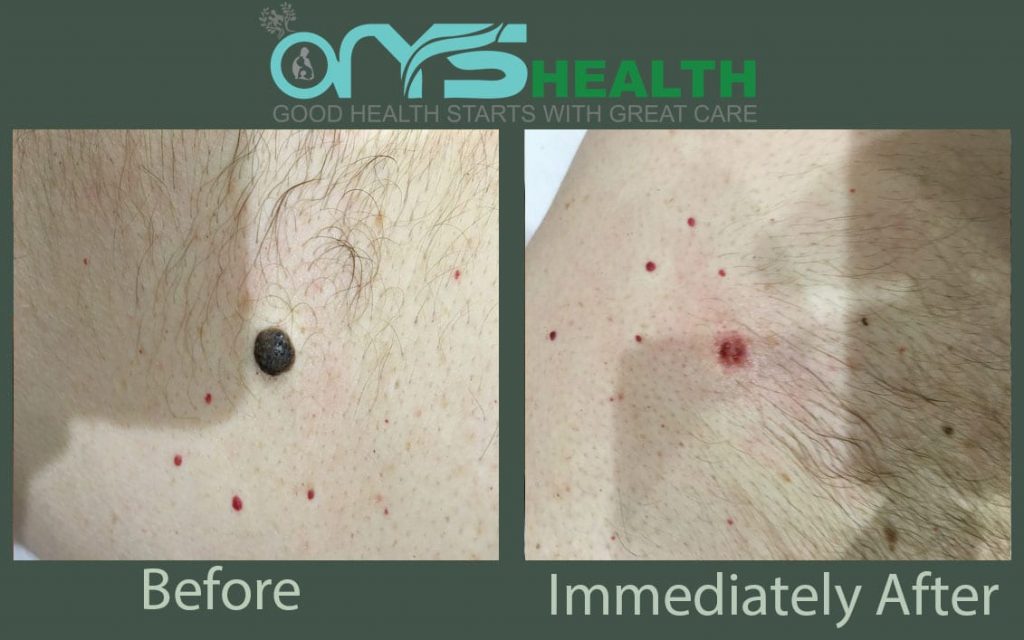 Before and after the treatment image