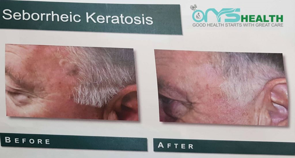 Seborrheic Keratosis before and after treatment image