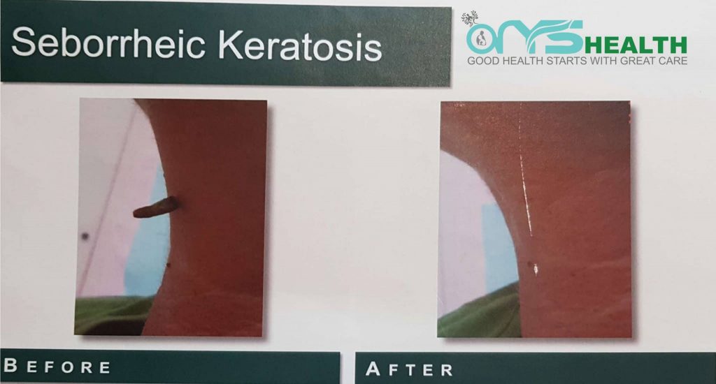 Seborrheic Keratosis Before and after the treatment image