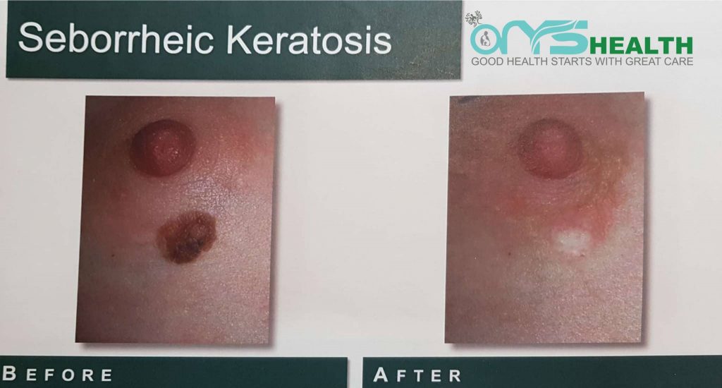 Before and After the treatment image