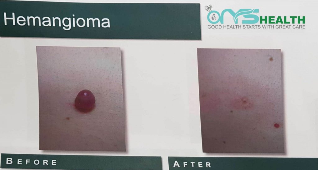 Hemangioma before and after the treatment image