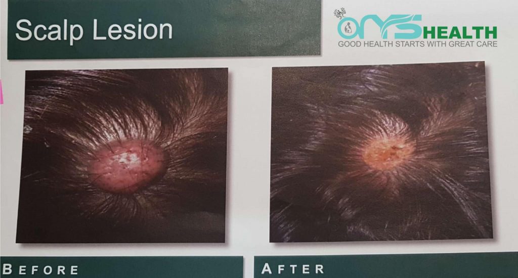 Scalp Lesion before and after the treatment image