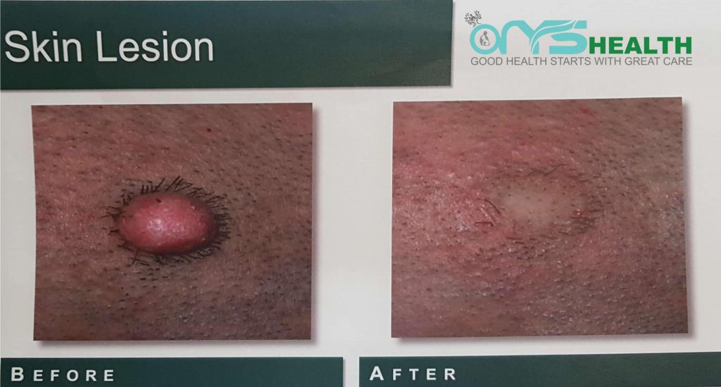 Skin Lesion Before and after the treatment image