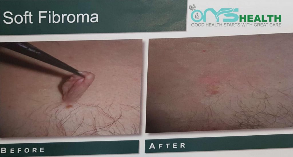 Soft Fibroma Before and after the treatment image