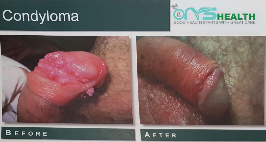 Condyloma Before and after the treatment image