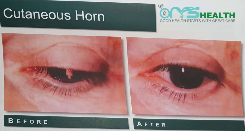 Cutaneous Horn Before and after the treatment image