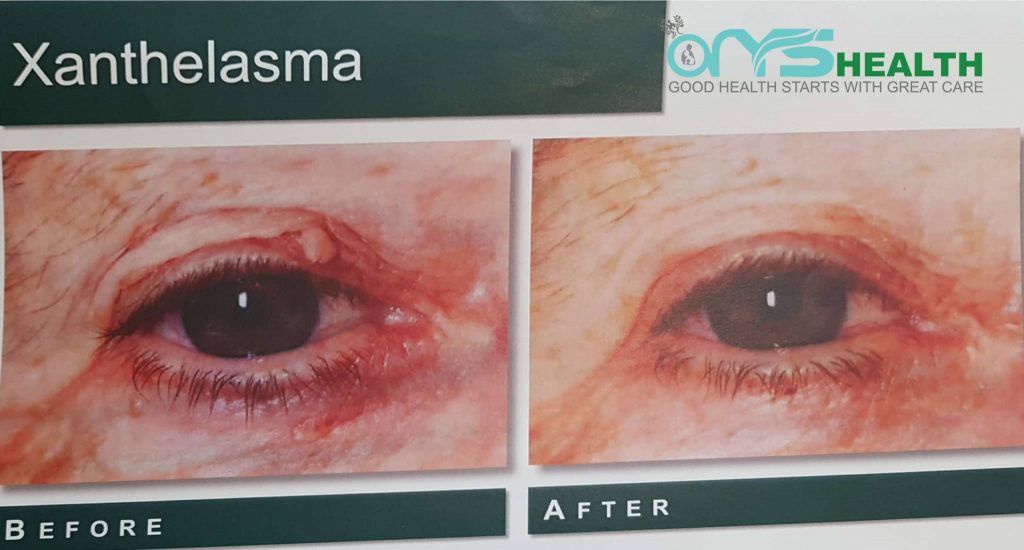 Xanthelasma Before and after the treatment image