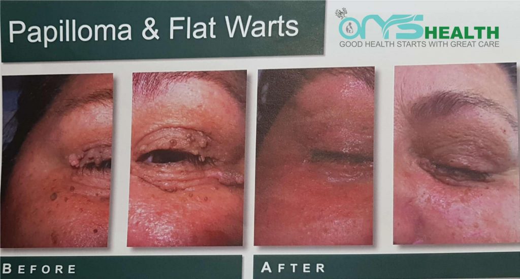 Papilloma & Flat warts before and after the treatment image