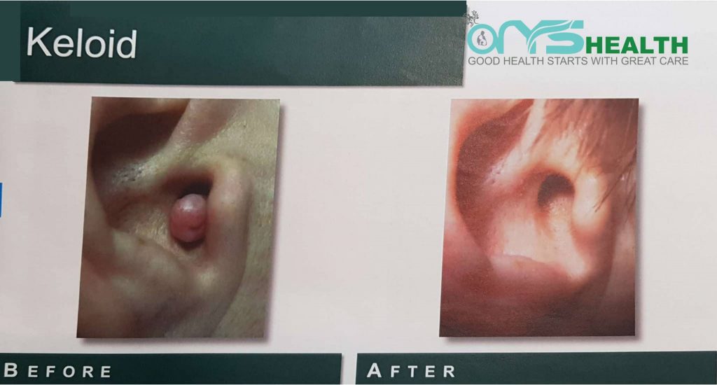 Keloid before and after the treatment image