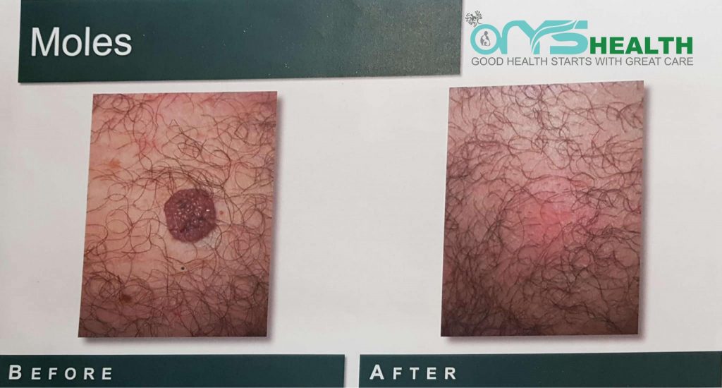 Moles before and after the treatment image
